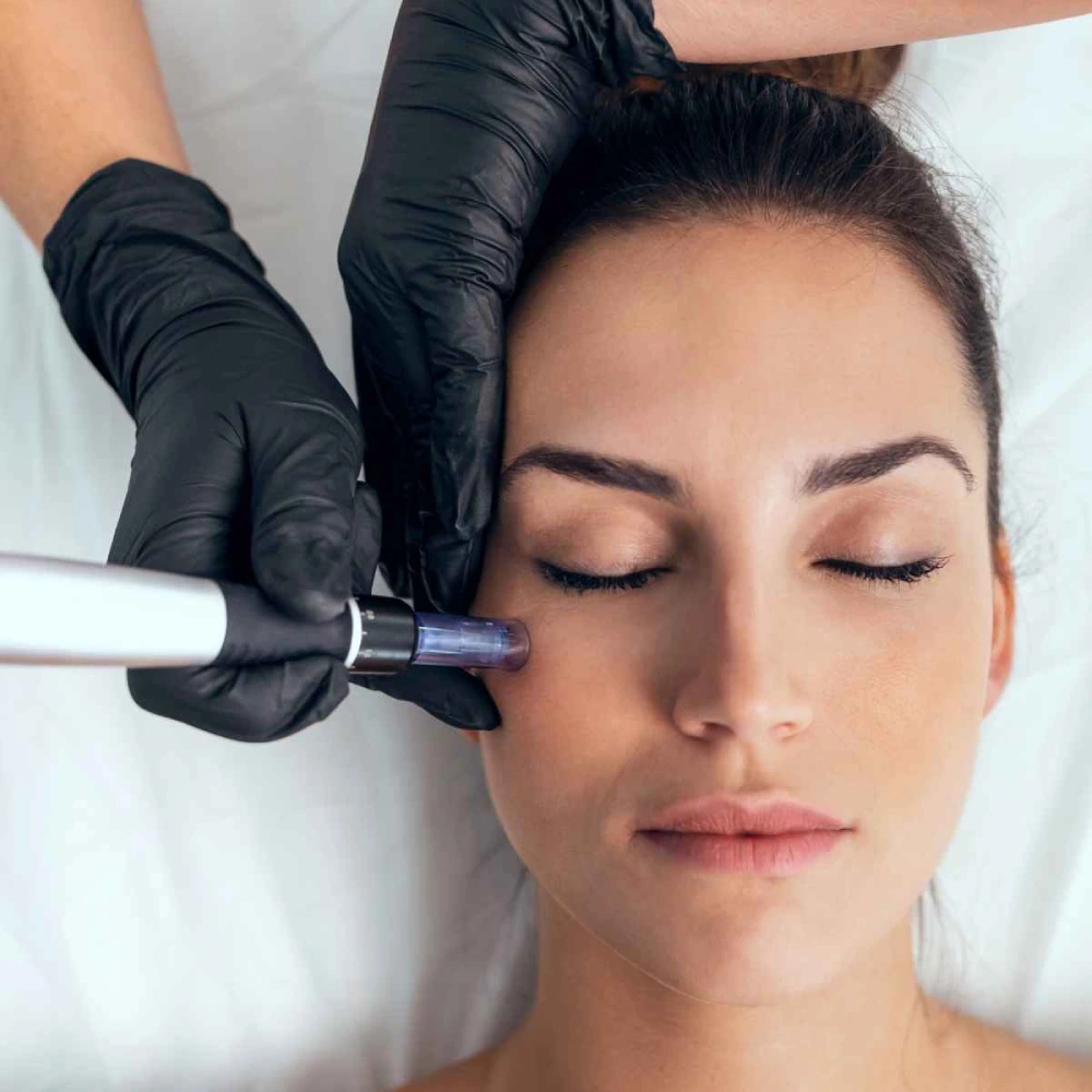 Tratamiento Facial Dermapen
